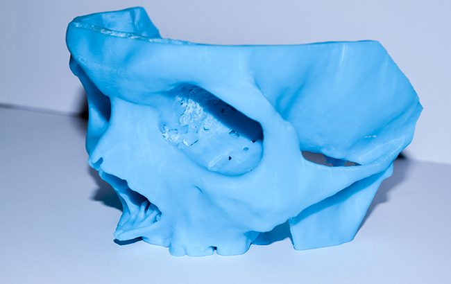ZORTRAX 3D Printed Skull Facial Reconstruction Surgery