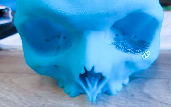 ZORTRAX 3D Printed Skull Facial Reconstruction Surgery Implant